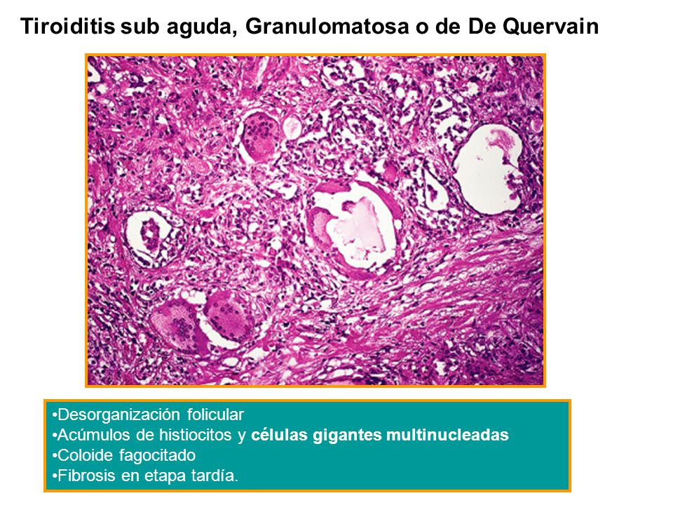 TIROIDITIS DE QUERVAIN PDF DOWNLOAD TIROIDITIS DE QUERVAIN PDF DOWNLOAD